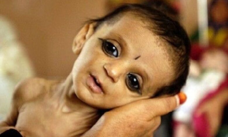 तीन गुना बढ़े कुपोषित बच्चे, योजनाएं बेअसर तीन गुना बढ़े कुपोषित बच्चे, योजनाएं बेअसर